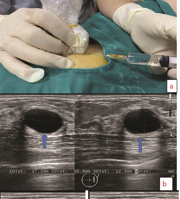 Miêu tả quy trình thực hiện kỹ thuật chọc hút diệt nang vú dưới hướng dẫn siêu âm.