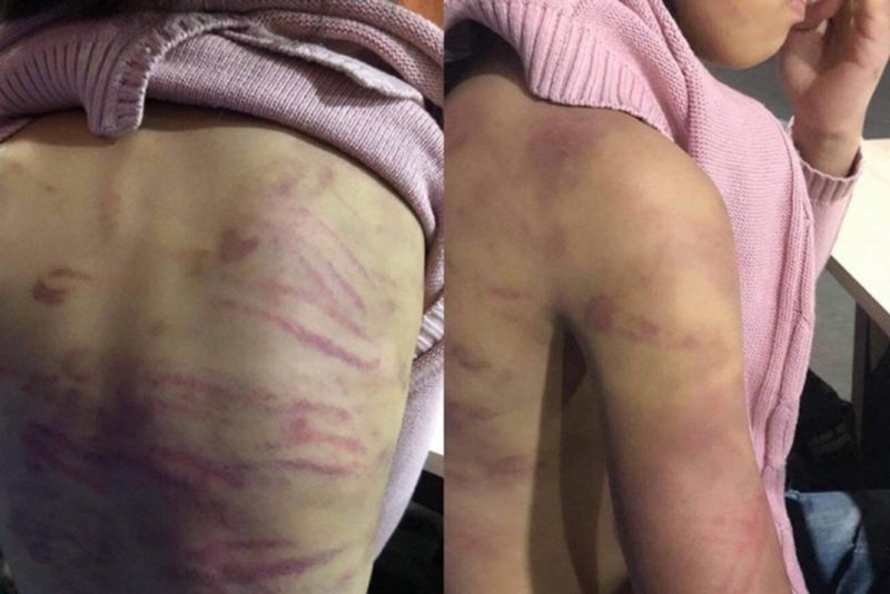 Hình ảnh cháu H.B, trú tại Hà Đông bị mẹ đẻ bạo hành và người tình của mẹ xâm hại