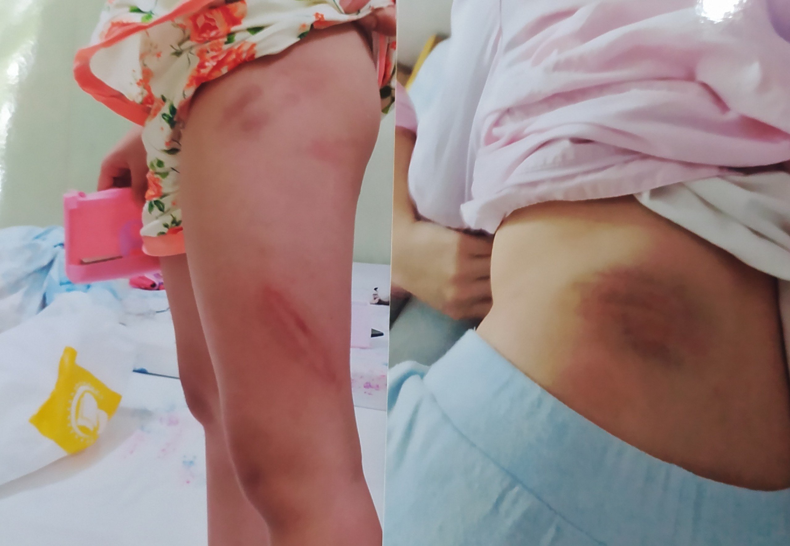 Những vết bầm tím trên cơ thể cháu bé nghi bị bố dượng đánh	Ảnh gia đình cung cấp