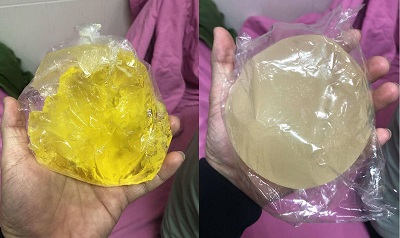 Gặp biến chứng vì túi nâng ngực “rởm” - ảnh 1