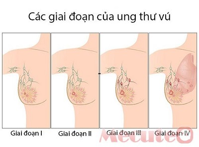 7 dấu hiệu ban đầu của bệnh ung thư vú - ảnh 1