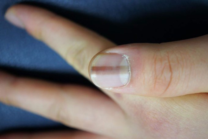 Những bất thường trên móng tay có thể là cảnh báo sớm của bệnh tật | Khỏe |  BÁO PHỤ NỮ THỦ ĐÔ - CƠ QUAN NGÔN LUẬN CỦA HỘI LIÊN HIỆP
