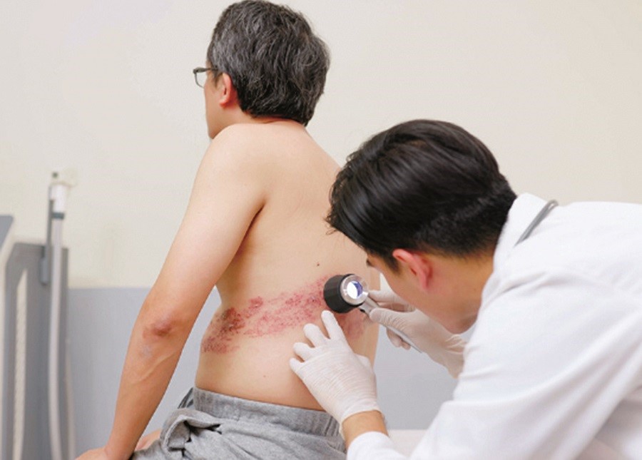 Zona thần kinh ở người cao tuổi - ảnh 1