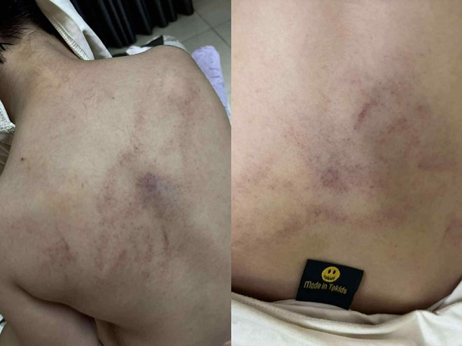Hà Nội yêu cầu xác minh việc trẻ mầm non nghi bị giáo viên bạo hành - ảnh 1