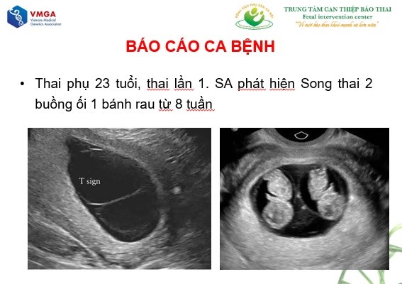 BV Phụ Sản Hà Nội: Công bố ca song thai cùng trứng khác kiểu gen, giới tính cực hiếm trên thế giới - ảnh 3
