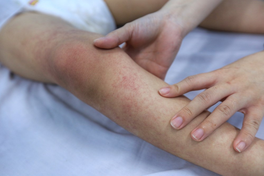 Sở Y tế Hà Nội tăng cường biện pháp phòng chống sốt xuất huyết - ảnh 2