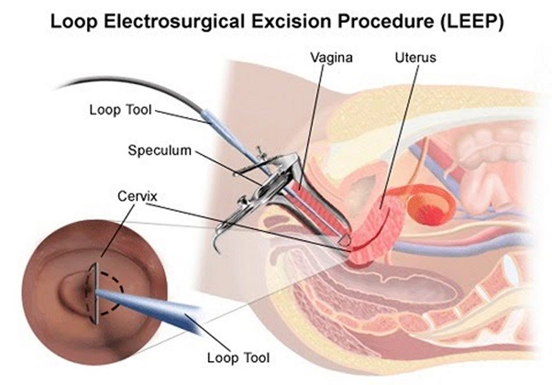 LEEP - thủ thuật loại bỏ tế bào bất thường ở cổ tử cung bằng vòng điện - ảnh 1
