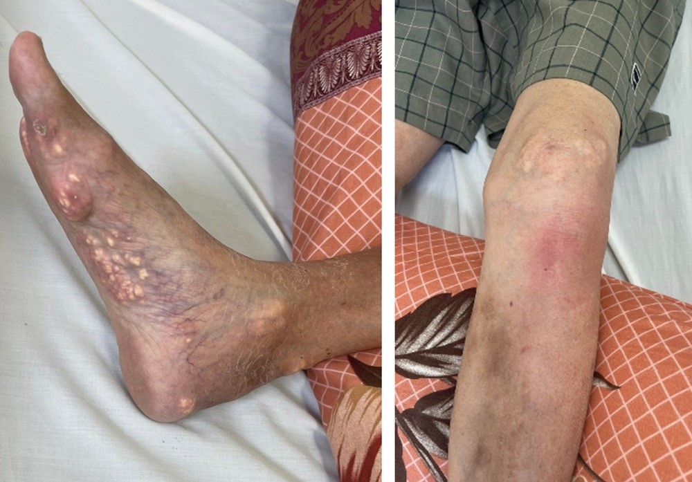 Cảnh báo nguy cơ tàn phế từ việc lạm dụng thuốc không rõ nguồn gốc điều trị bệnh gút - ảnh 1