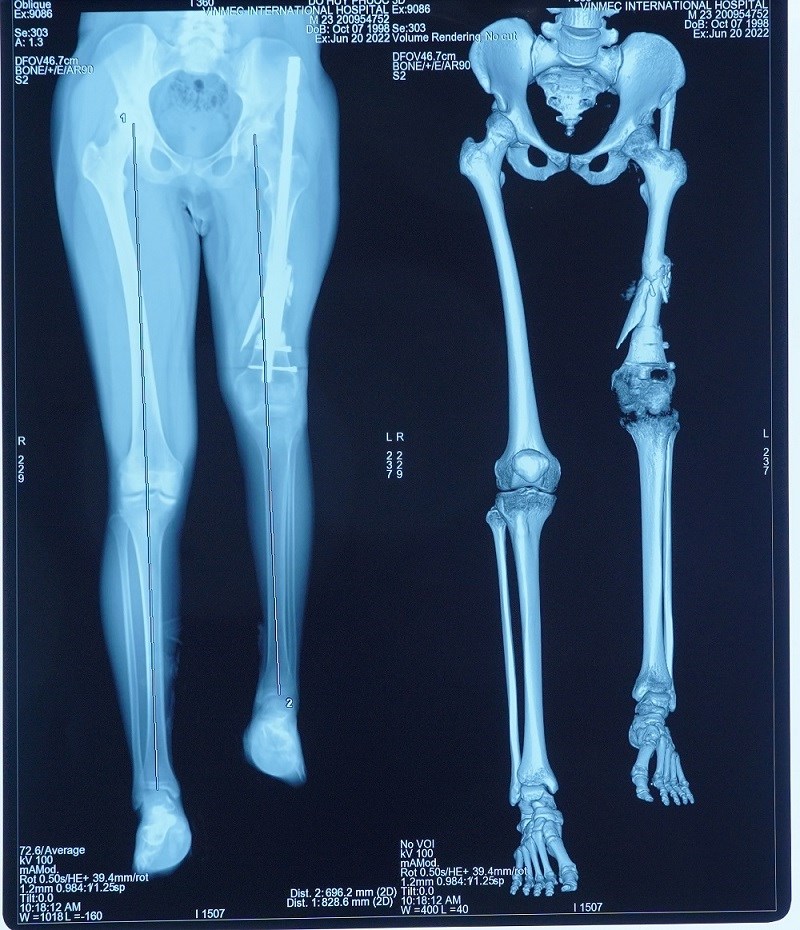 Lần đầu tiên tại Việt Nam, kéo dài chân 13cm cho bệnh nhân ung thư xương - ảnh 3