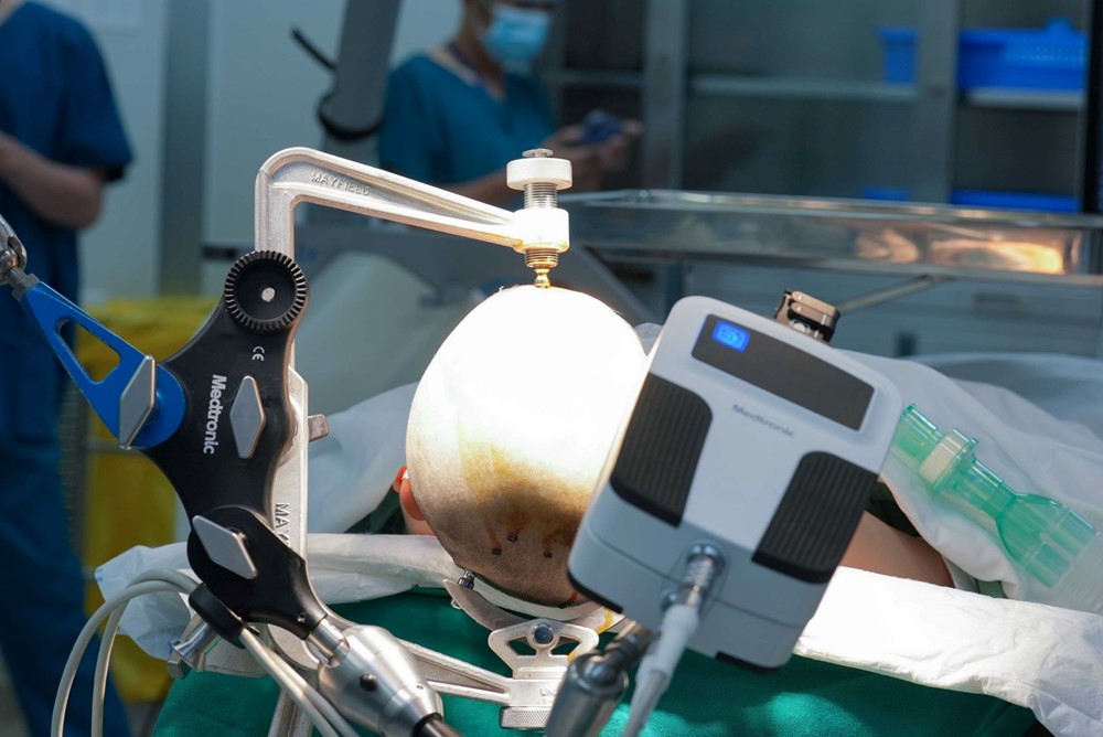 Vinmec Central Park mở lối đi mới trong điều trị động kinh bằng công nghệ Robot đỉnh cao - ảnh 1