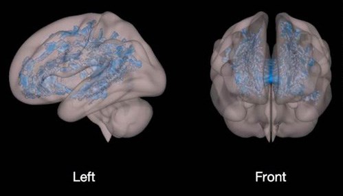Đây là bên trái và phía trước não bộ của trẻ hay xem thiết bị điện tử. Phần màu xanh cho thấy sự kém phát triển lan rộng và sự thiếu tổ chức của chất trắng cũng ở chính khu vực hỗ trợ việc học tập của trẻ.