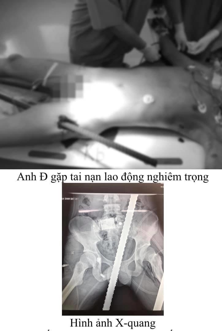 BV Việt Đức cứu sống thành công thanh niên bị 2 thanh sắt đâm xuyên tầng sinh môn, bụng, ngực, đùi - ảnh 1