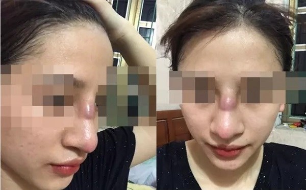 Mũi của bệnh nhân 19 tuổi bị nhiễm trùng sau 1 tháng phẫu thuật thẩm mỹ.
