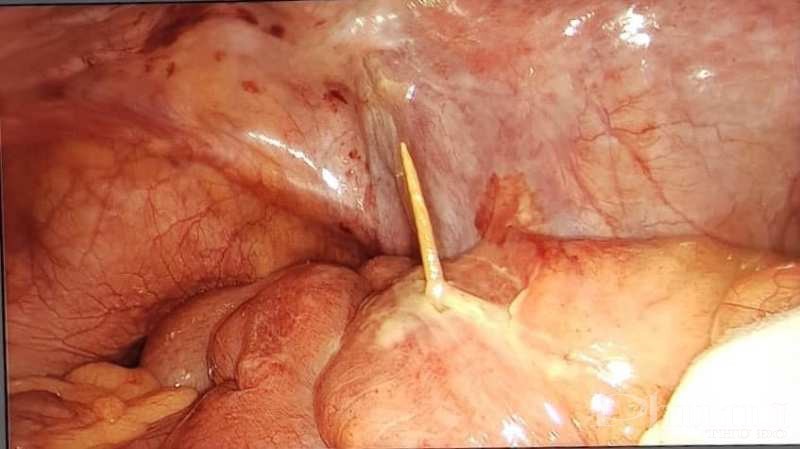 Hình ảnh nội soi, kiểm tra ổ bụng của bệnh nhân H cho thấy có dị vật que tăm đâm thủng ruột non.