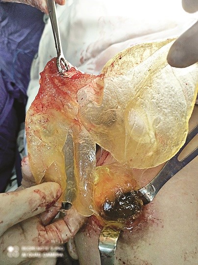 Hình ảnh túi nâng ngực silicon bị vỡ được lấy ra khỏi cơ thể chị N.T.P  	(Ảnh: BVCC)