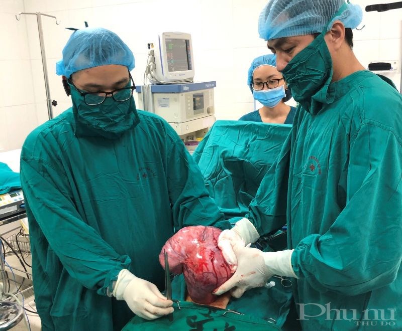 Bác sĩ BV Phụ sản Hà Nội thực hiện phẫu thuật bóc tách khối u xơ tử cung gần 4kg.