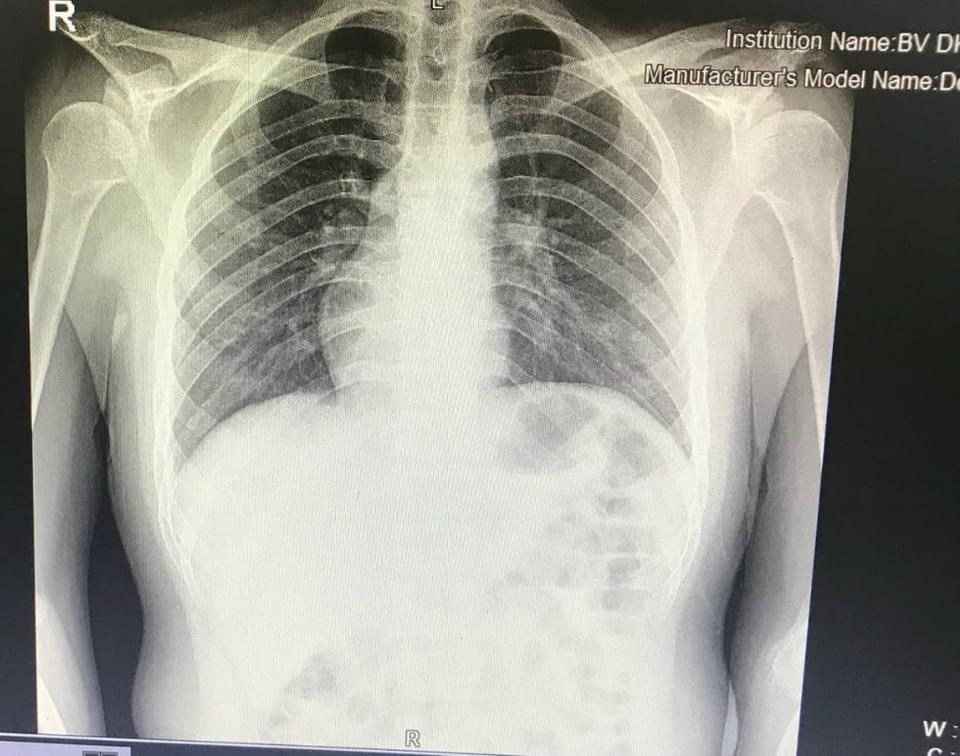 Hình ảnh chụp phim X-quang của bệnh nhân.