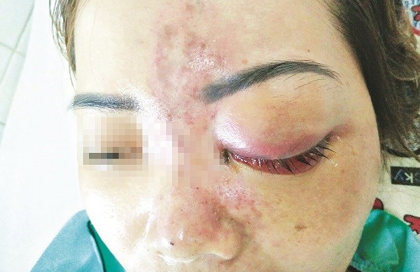 Một phụ nữ bị mù mắt vì tiêm filler tại spa không phép. Ảnh: Int