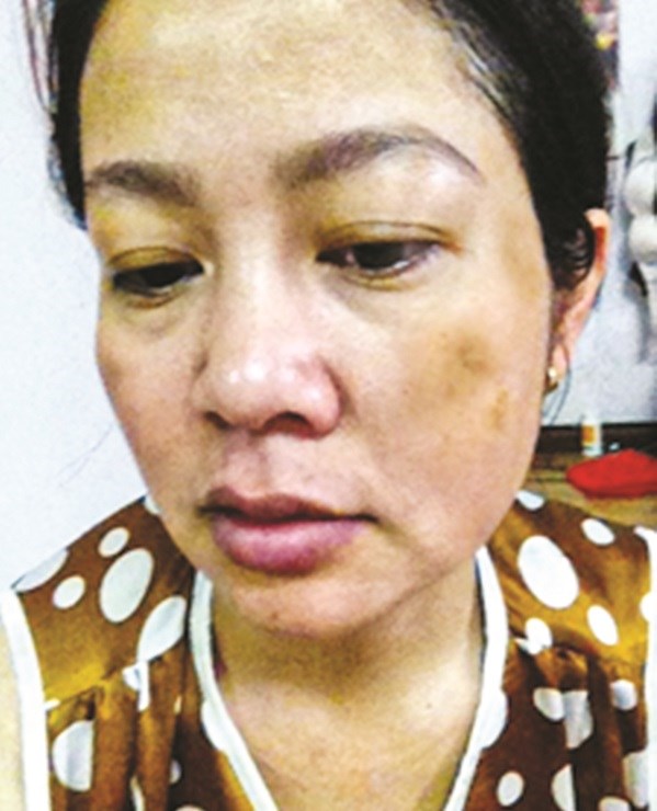 Chị Trần Thu Hương trước khi sử dụng sản phẩm Đông y trị nám của mình
