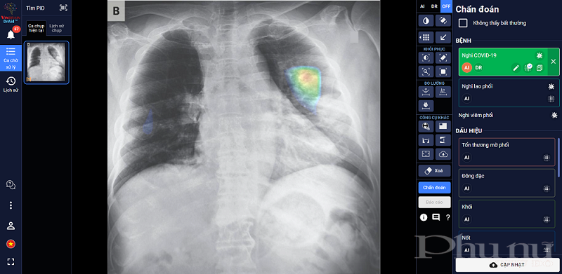 DrAid™ chẩn đoán và tiên lượng điều trị bệnh nhân COVID-19 dựa trên hình ảnh X-quang ngực thẳng.