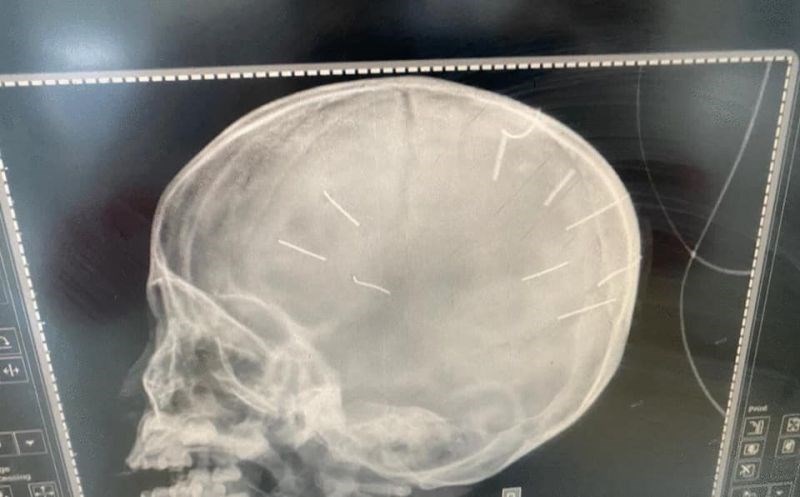 Hình ảnh chụp não cháu bé có 9 đinh ghim vào đầu