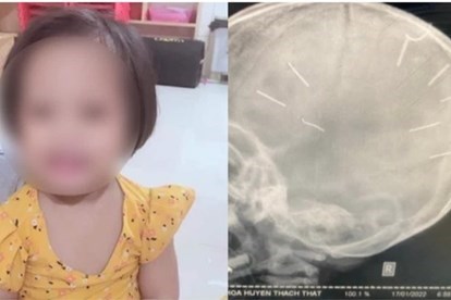 Hình ảnh cháu bé V.N.A - 3 tuổi bị đinh ghim vào đầu 	p