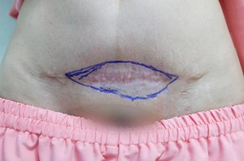 Vùng da bụng bị teo của chị L sau tiêm corticoid mờ sẹo	Ảnh: BSCC