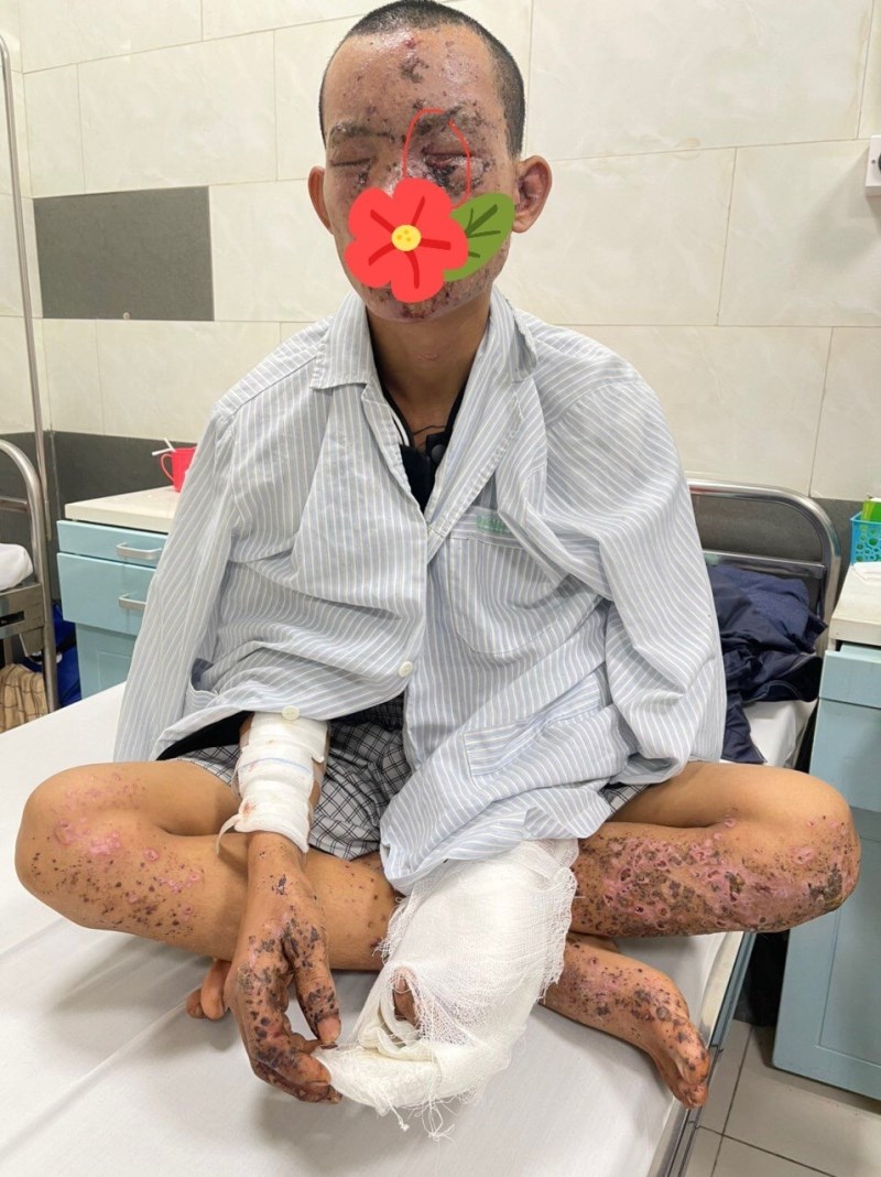 Bệnh nhân Tuấn trong thời gian điều trị tại Bệnh viện Bạch Mai: mất thị lực, cháy sém toàn thân và tổn thương nhiều cơ quan.
