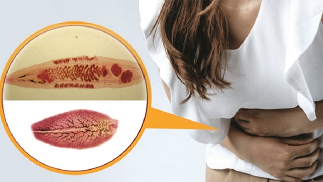 Nhiễm sán lá gan nặng vì thói quen ăn đồ tái, sống