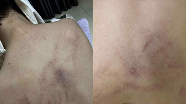 Hà Nội yêu cầu xác minh việc trẻ mầm non nghi bị giáo viên bạo hành
