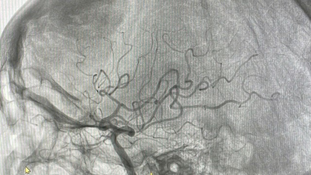 Cấp cứu thành công bệnh nhân đột quỵ não do tắc động mạch não giữa bằng kỹ thuật hút huyết khối