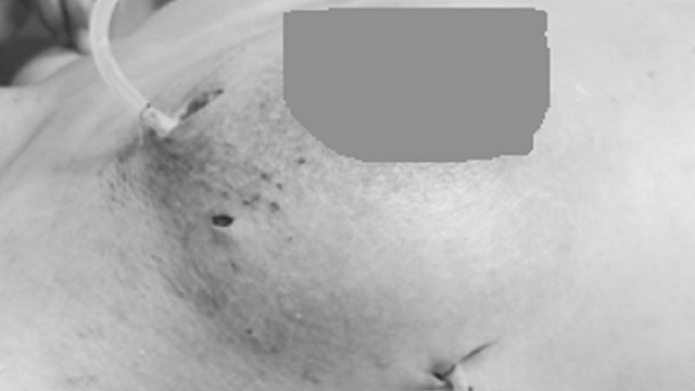 Suýt mất ngực vì tin lời quảng cáo “Nâng ngực không phẫu thuật“