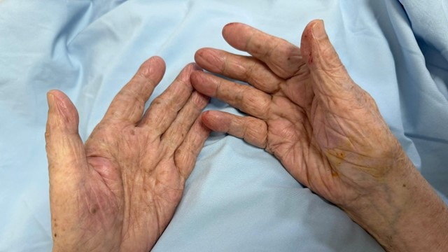 Bệnh viện Hữu Nghị: Can thiệp kịp thời, cứu thành công cánh tay cho bệnh nhân 97 tuổi bị tắc mạch chi cấp