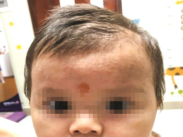 Rôm sảy ở trẻ em