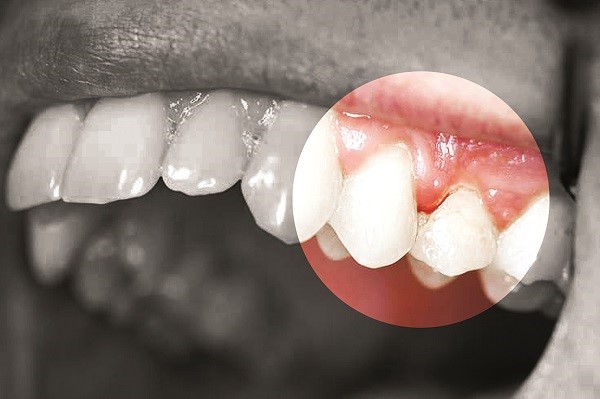 Không chủ quan với bệnh viêm lợi