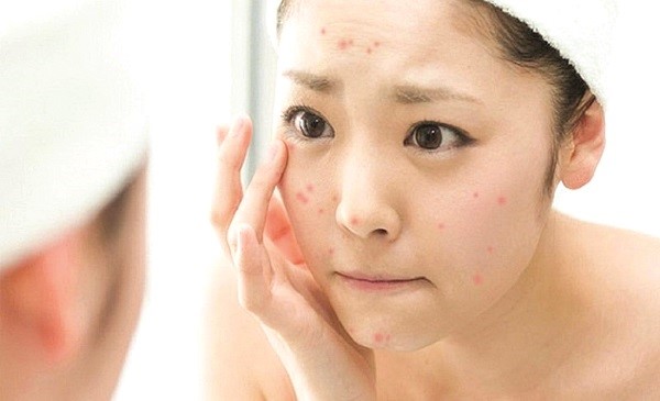 Các cách để “tiễn biệt” mụn cám 