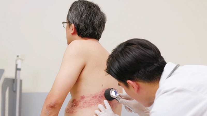 Zona thần kinh ở người cao tuổi