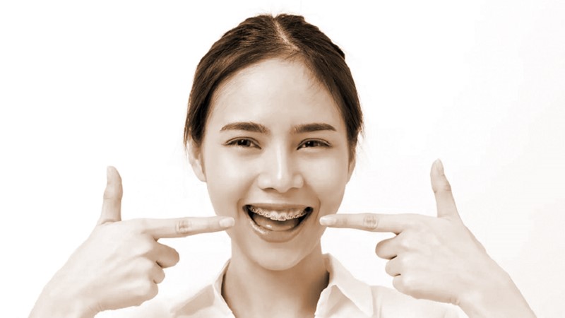 Niềng răng và lưu ý chăm sóc răng miệng