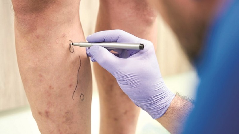 Suy tĩnh mạch chi dưới 