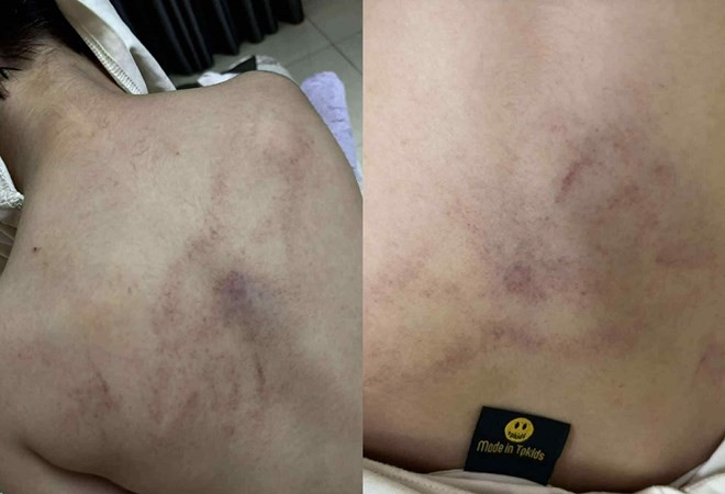 Hà Nội yêu cầu xác minh việc trẻ mầm non nghi bị giáo viên bạo hành