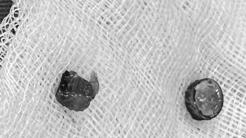 Bé gái 5 tuổi viêm âm hộ vì nhét pin vào “vùng kín“