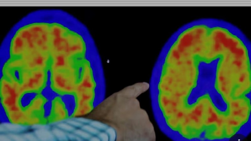 Thuốc mới mang đến hi vọng chữa bệnh Alzheimer từ năm 2024