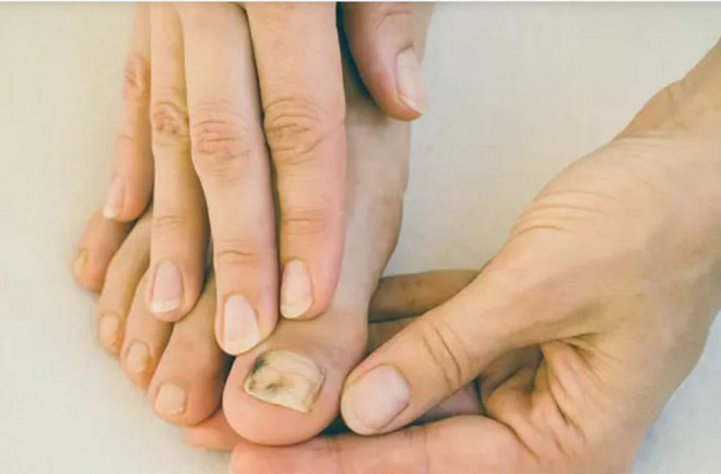 Tưởng viêm loét móng chân, nào ngờ bị ung thư tế bào hắc tố