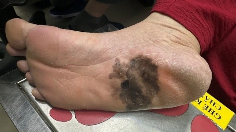 Ung thư da ác tính: Bác sĩ da liễu cảnh báo về dấu hiệu đốm đen trên bàn chân