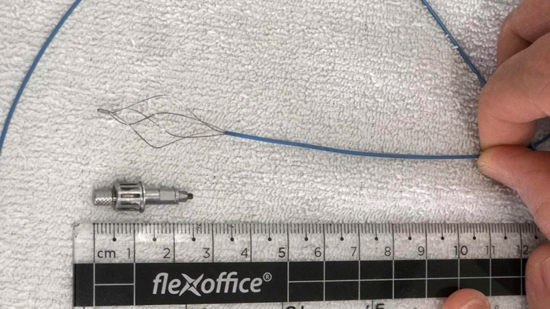 BV Hữu Nghị cấp cứu thành công ca dị vật phế quản nguy hiểm hiếm gặp