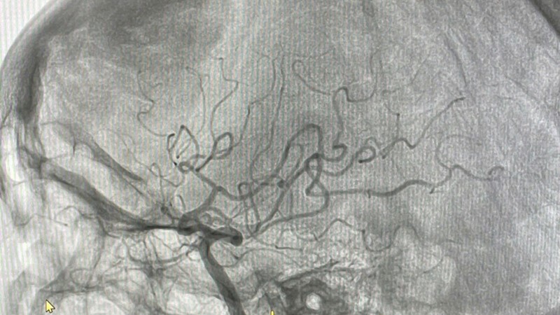 Cấp cứu thành công bệnh nhân đột quỵ não do tắc động mạch não giữa bằng kỹ thuật hút huyết khối