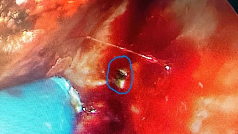 Bệnh viện Hữu nghị phẫu thuật thành công ca dị vật vách ngăn mũi tồn dư hơn 40 năm