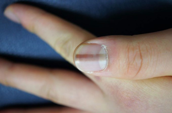 Những bất thường trên móng tay có thể là cảnh báo sớm của bệnh tật