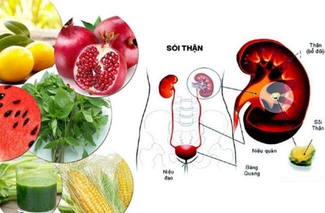 Bệnh nhân sỏi thận nên ăn gì?