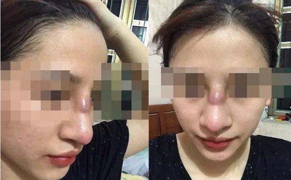 Nâng mũi tại spa, cô gái 19 tuổi suýt "mất mũi"
